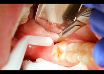 wisdom tooth extracted